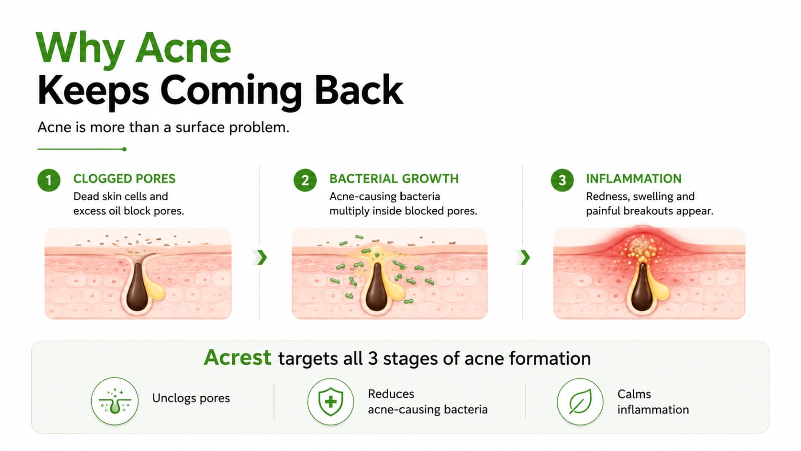 Acrest Target Acne Gel 15ML